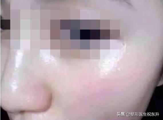 打水光针跟一般的会有什么不一样,水光针补水打完大概会有什么效果