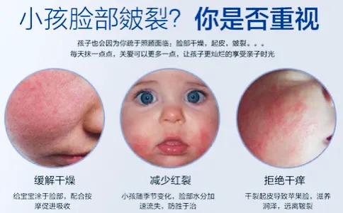 宝宝脸部皴红干痒,宝宝脸部皴了的表现