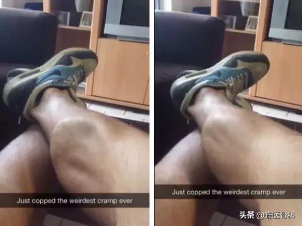 孩子缺钙腿抽筋怎么办快速缓解,孕晚期不缺钙腿抽筋怎么缓解