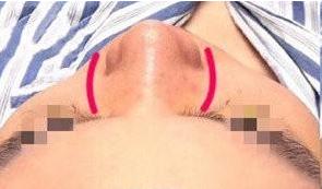 鼻骨太宽是怎样引起的,鼻骨太宽应该如何改善