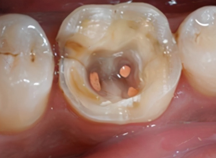 蛀牙修复之后要注意什么,蛀牙了在家里就能解决的办法