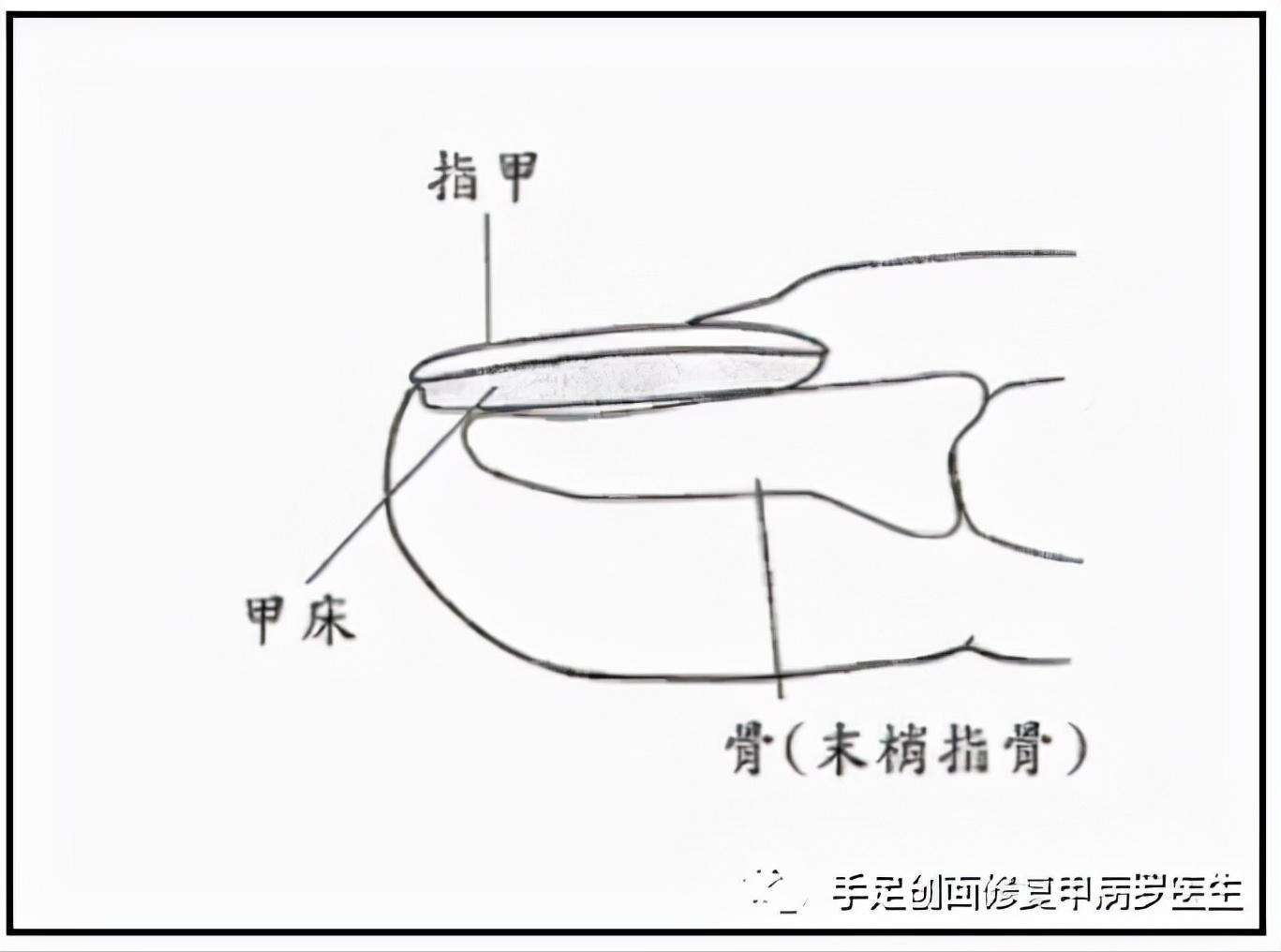 甲下积血怎么处理,甲下积血不排血会胀痛吗