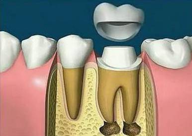 抽牙神经对牙齿有什么影响,牙齿为什么要取神经