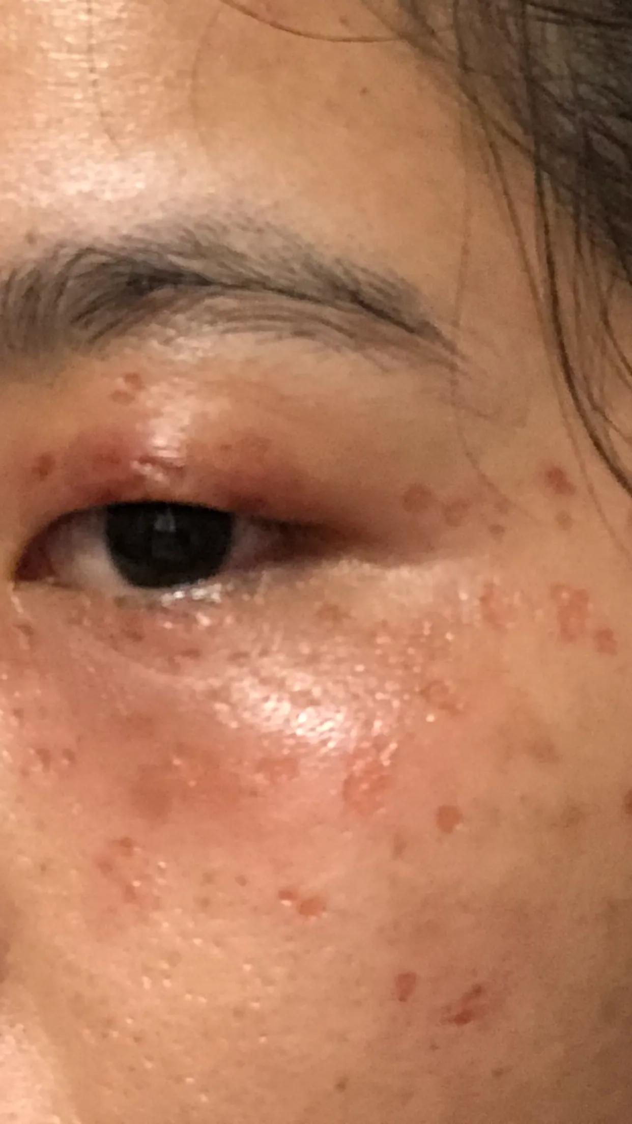 脂肪粒最好的处理方式,脂肪粒的正确处理方法