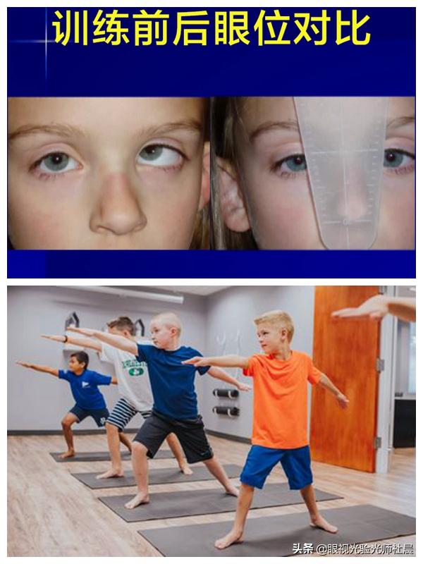 屈光参差性弱视和屈光不正性弱视,屈光不正性弱视最佳治疗方法