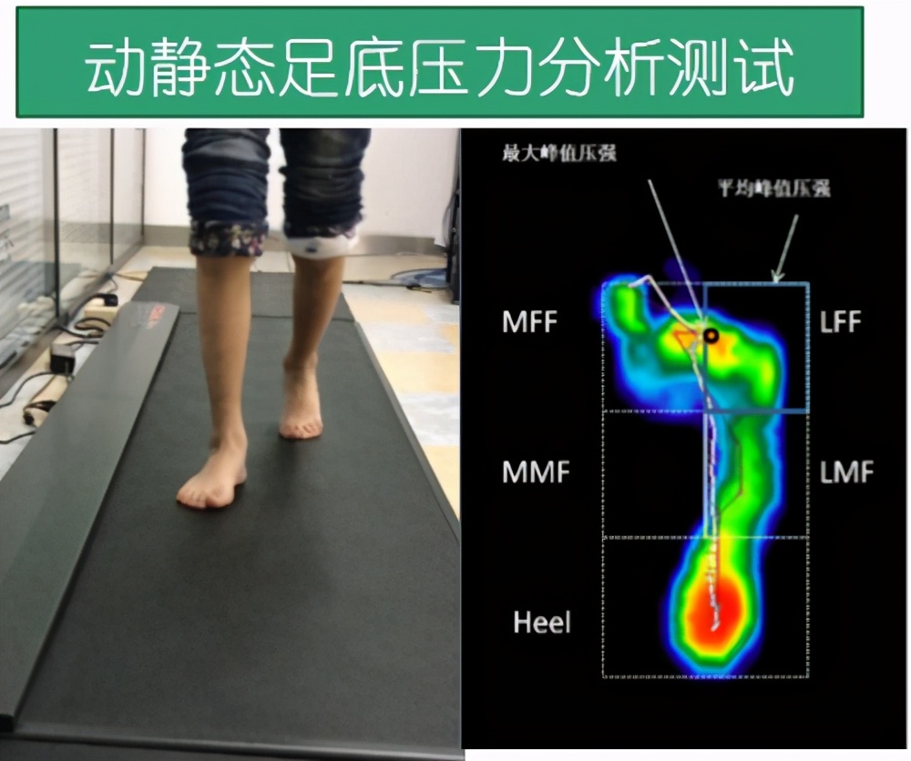 定制矫正鞋鞋垫,定做矫正鞋的地方在哪里