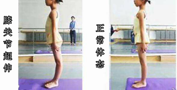 超膝伸肌肉腿怎么矫正,膝超伸和o型腿怎么改善