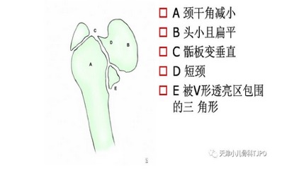 儿童髋外翻怎么治疗,儿童髋内翻是什么原因