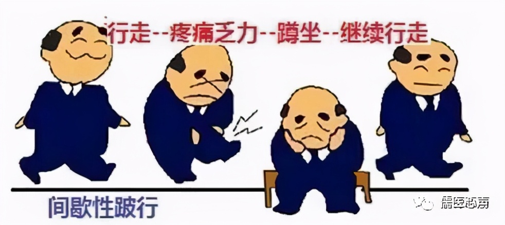 腰痛捉妖记（二十三）------没有受伤，我的腰椎怎么就滑脱了？