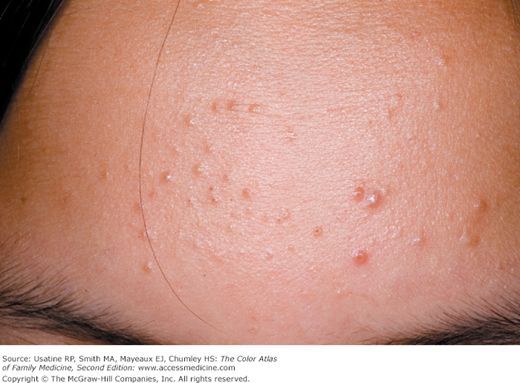 女生闭口痘痘怎么处理好得快,女生脸上有闭口痘痘怎么解决