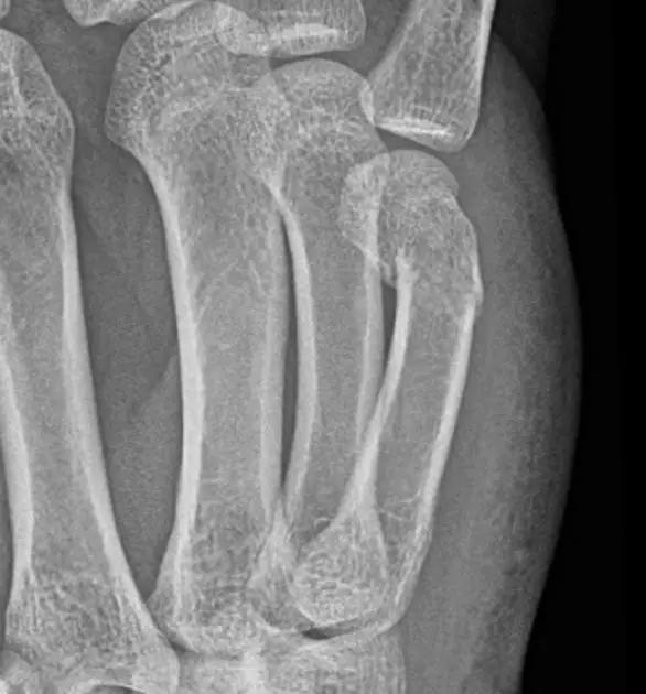 特殊骨折类型,特殊骨折体征