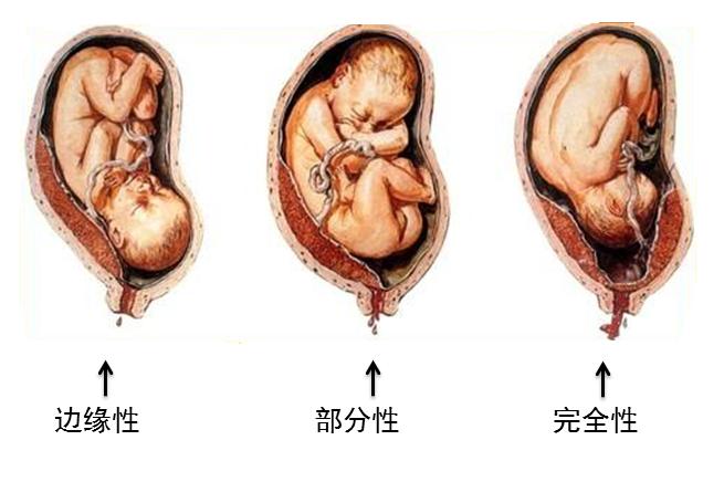 医生说胎盘不低是什么意思,胎盘低会变成前置胎盘吗