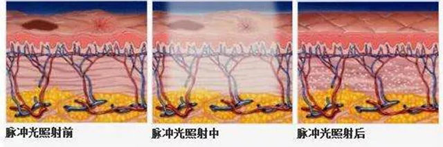 这才是祛痘印最正确的打开方式,全球公认最有效的祛痘印方法