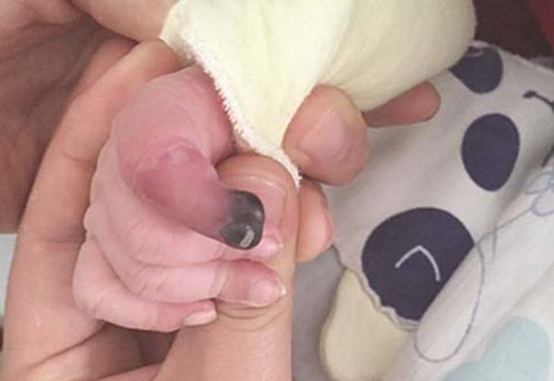 婴儿胳膊突然肿了,宝宝手臂肿了一块鼓起来