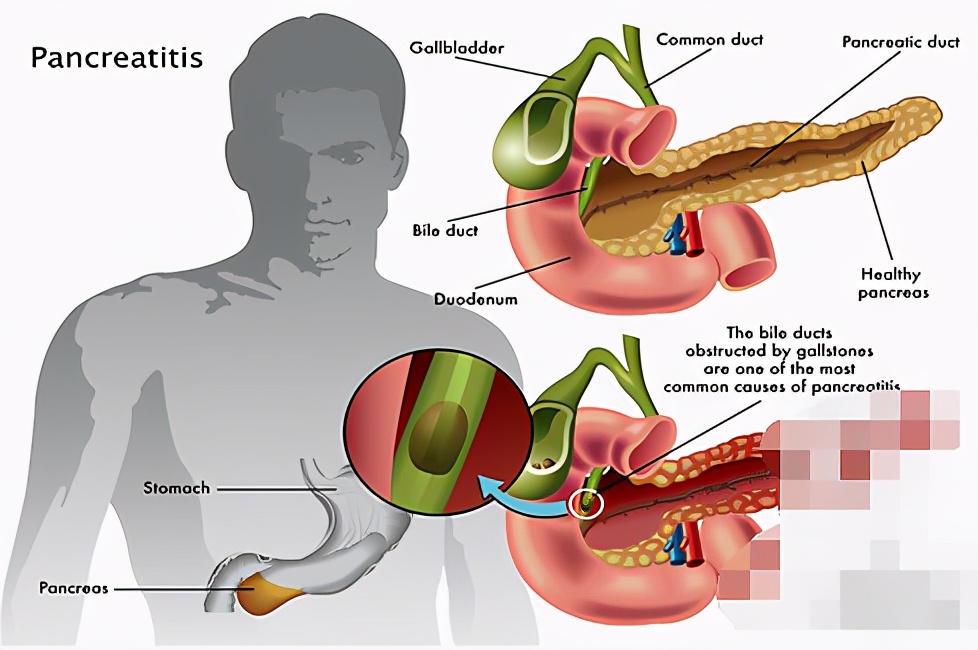 做了胆结石多长时间可以吃鸡蛋羹,胆结石吃鸡蛋羹好还是吃煮鸡蛋好
