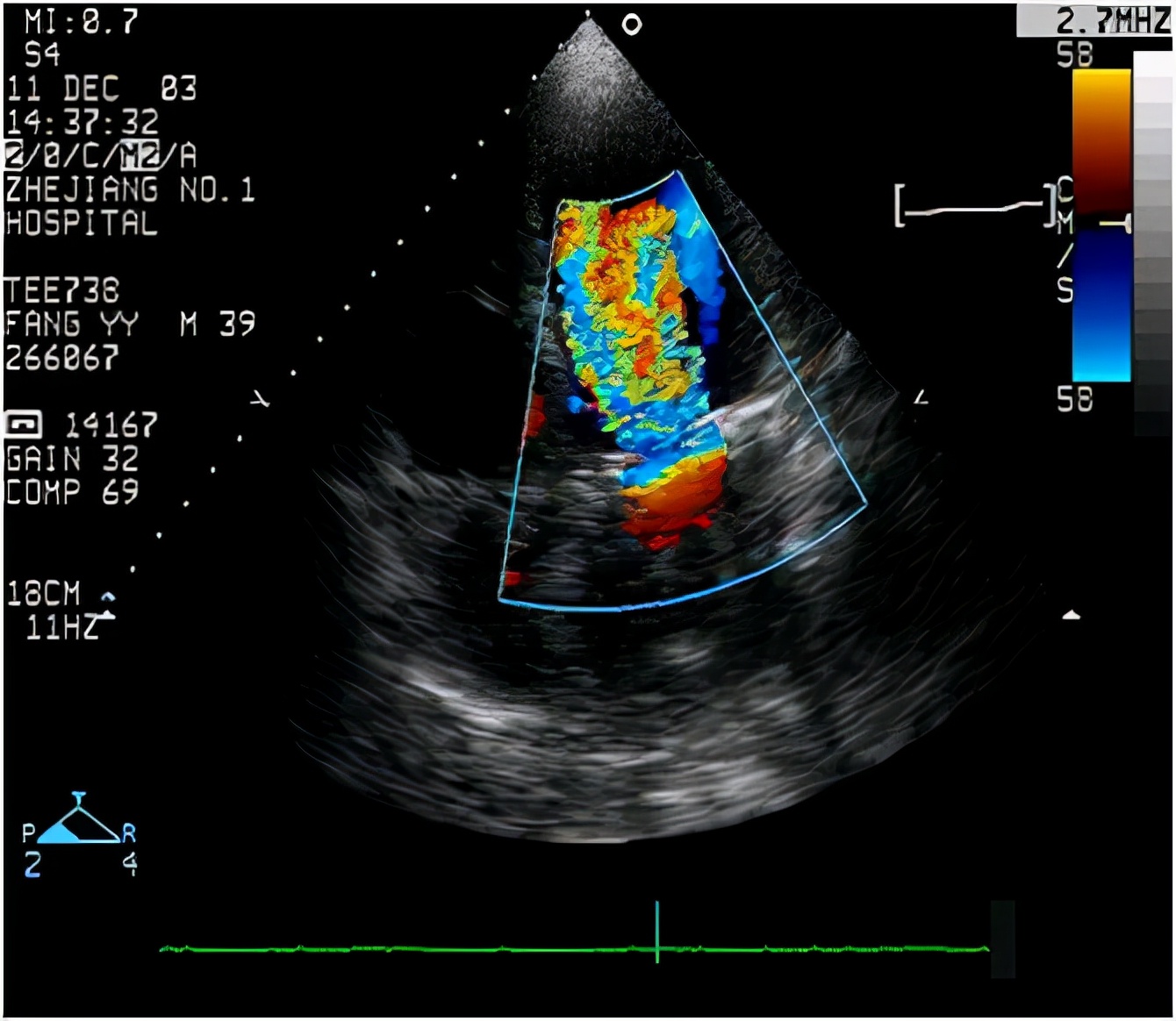 女子去医院体检发现心脏有五个洞,48岁女性检查出心脏有好几个洞