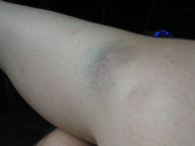 腿部突然出现问题,腿部出现异常信号