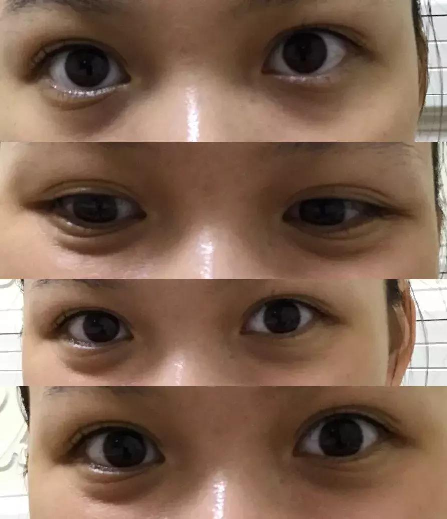 改善眼袋仅980元不开刀让你更出众,消除眼袋细纹大概多少钱