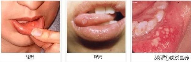 口腔溃疡一直疼痛,口腔溃疡反复发作教你一招