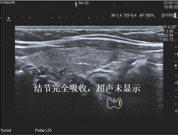 甲状腺结节微创消融手术,甲状腺结节微创消融医保