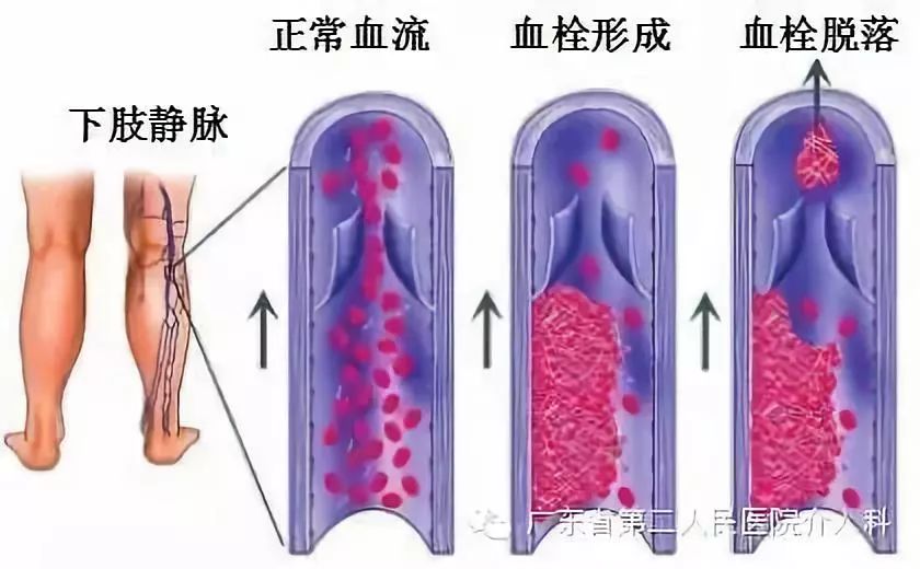 左腿血栓的最快消除方法,左腿浮肿有血栓用什么药治疗