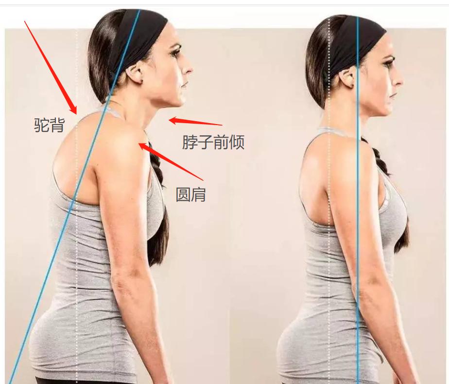 斜方肌越练越大的原因女的,斜方肌厚显得脖子短