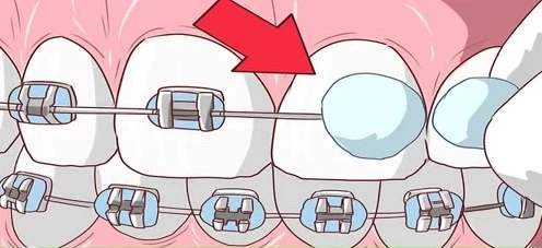 戴牙套是什么感受,戴牙套是什么体验的视频