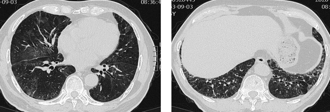 抗合成酶综合征是肺纤维化吗,抗合成酶综合征体征