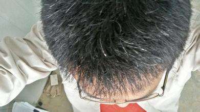 为什么有些人脖子下面有一条线,为什么有的人脖子长汗毛