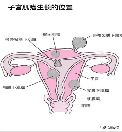子宫肌瘤和囊肿有什么症状,子宫肌瘤病因病机
