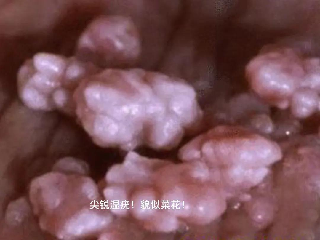 hpv每个女人都会经历么,hpv伤害性有多大