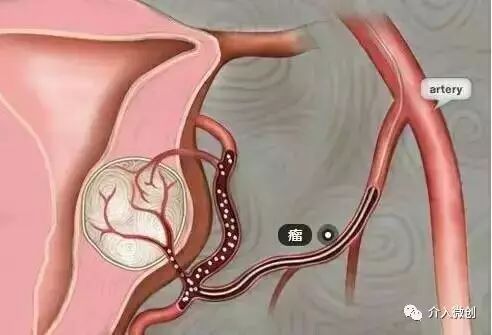 子宫腺肌病微创介入治疗时机