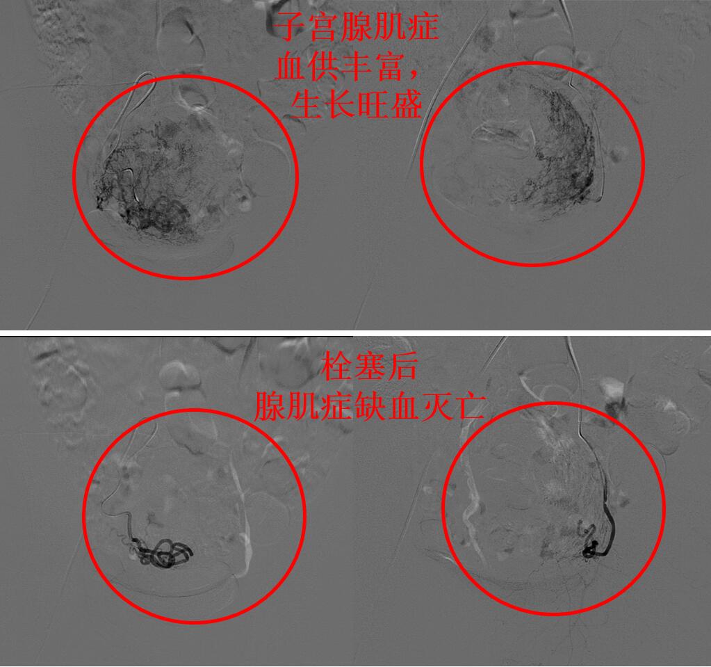 子宫腺肌症痛经中医能治好吗,子宫腺肌症引起的痛经艾灸哪里
