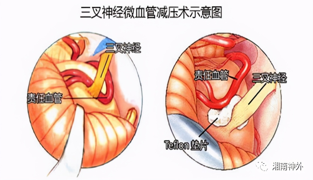 湘南学院附属医院罗忠平,湘雅神经外科罗忠平