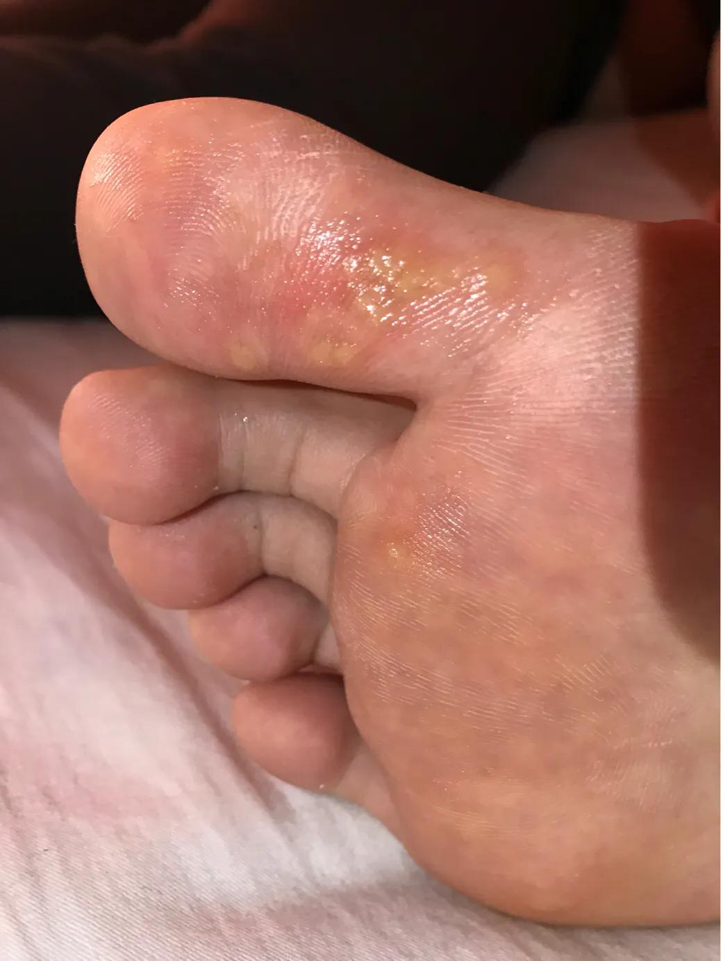 跖疣初期变化过程,跖疣详情