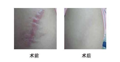 身上有疤的人多吗,身上有疤痕的人怎么样