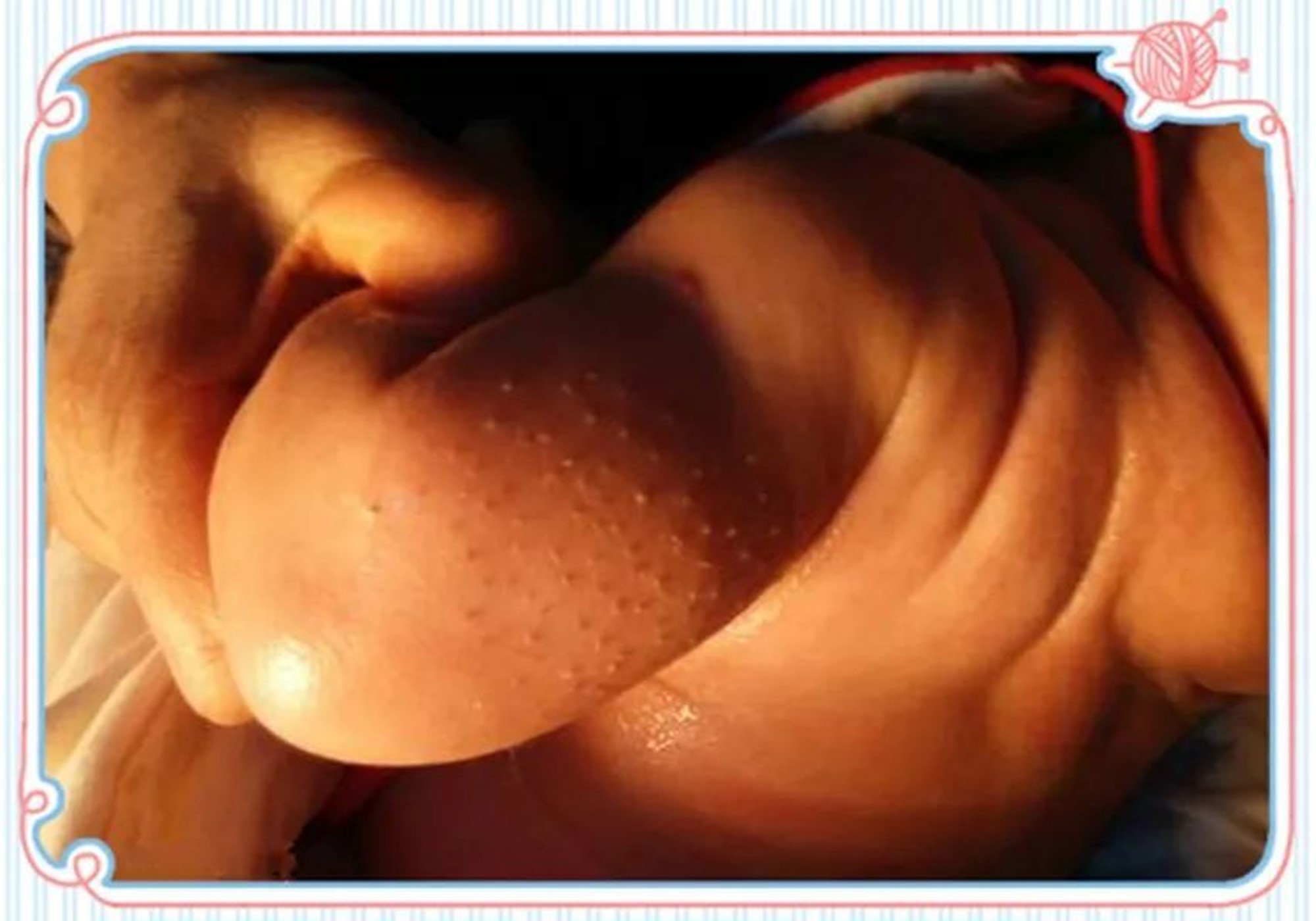 宝宝身上长有小黑刺怎么办,新生儿背部长黑刺怎么治