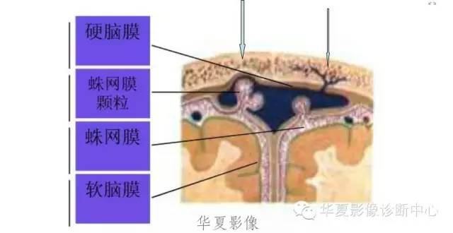 一文读懂颅内胆脂瘤,一文看懂背后的真相