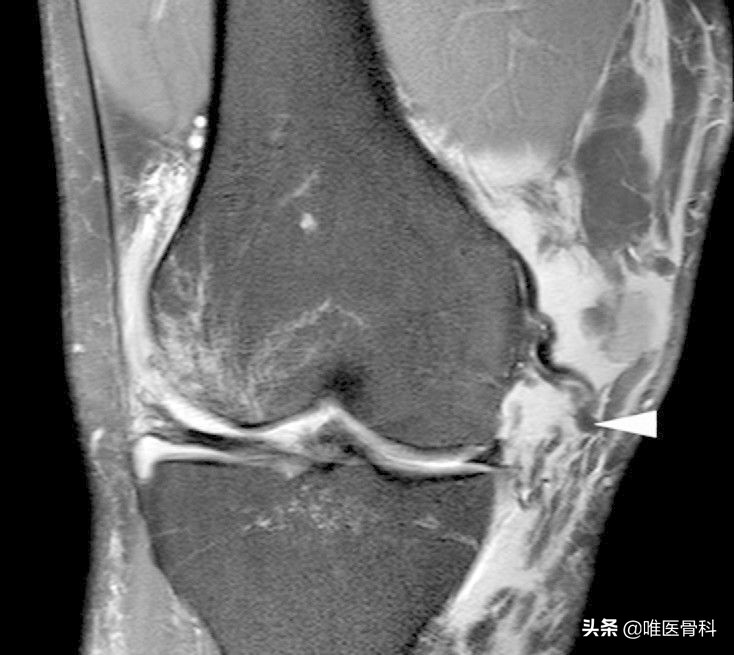 膝关节半月板损伤的相关知识,膝关节软骨损伤科普