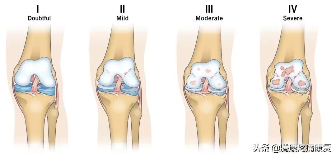 理疗对骨性关节炎有什么作用,骨性关节炎炎症怎么消除