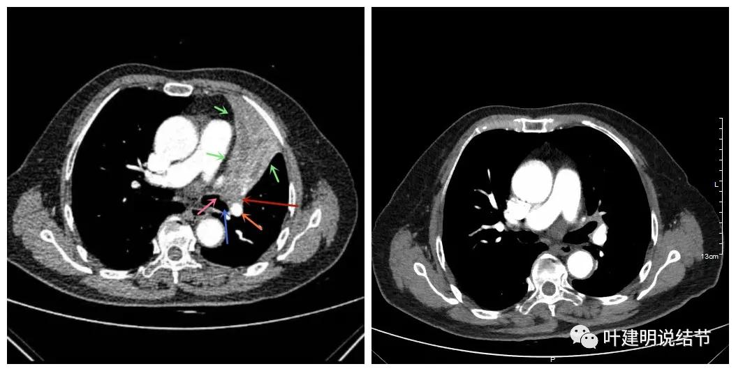 卡瑞利珠单抗治疗肺鳞癌有用吗,特瑞普利单抗对鳞癌治疗有效吗