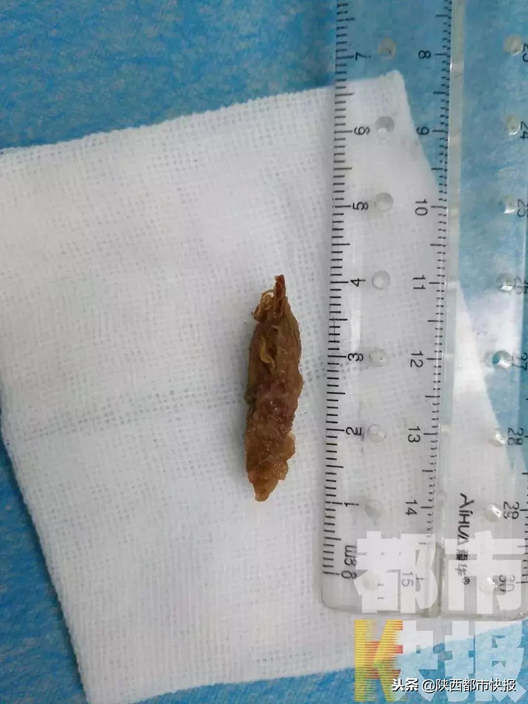 孕妇吃枣把枣核吞下去了没事吧,孕妇吃红枣不小心把核吞了