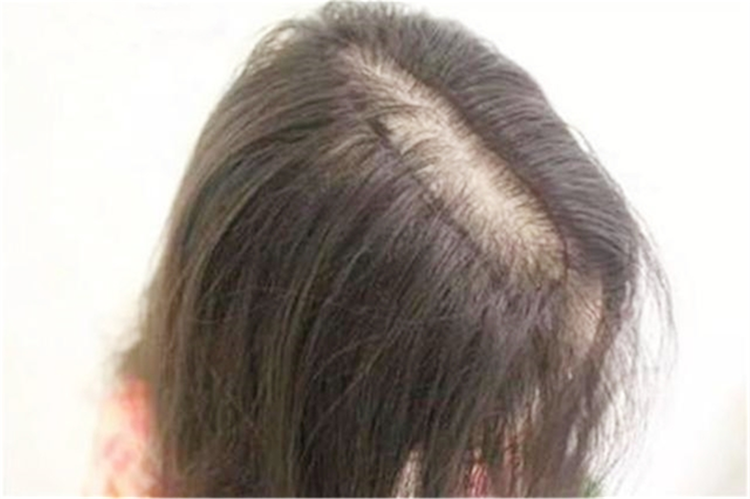 张歆艺产后脱发了吗,张歆艺担心产后脱发