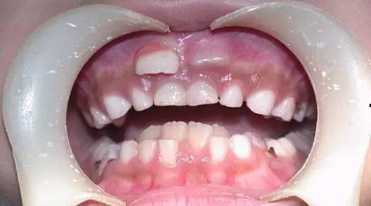 乳牙蛀掉只剩牙根影响恒牙萌出吗,乳牙蛀了要不要做根管