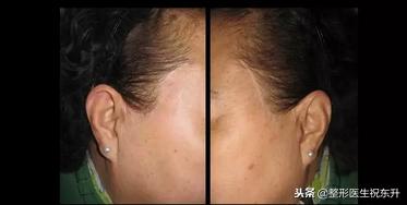 额颞部除皱去抬头纹怎么样,拉皮除皱抬头纹全过程视频