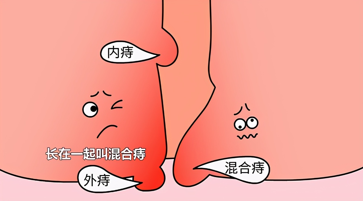 痔疮用痔疮栓好还是痔疮膏好,治痔疮是痔疮膏还是痔疮栓效果好