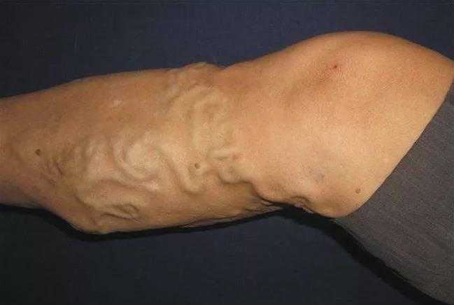 缓解静脉曲张的运动方法3种,缓解腿部静脉曲张最好的药