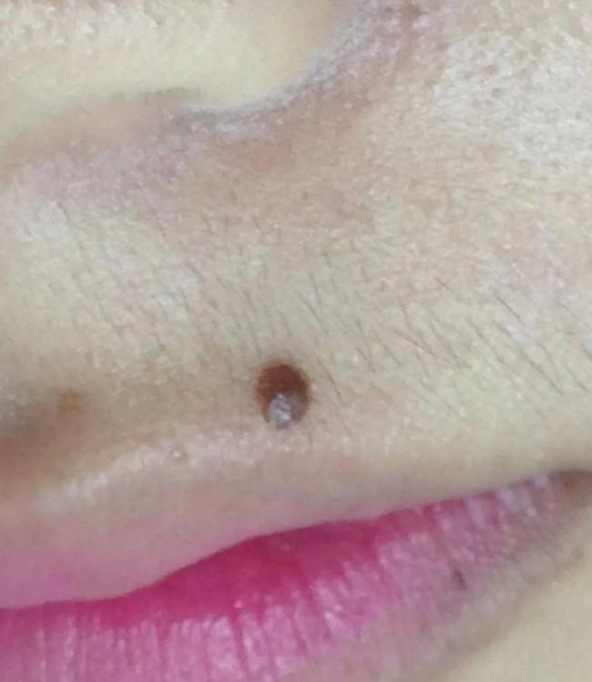 点痣留下了疤痕怎么祛,点痣留下的疤痕怎么消除最有效