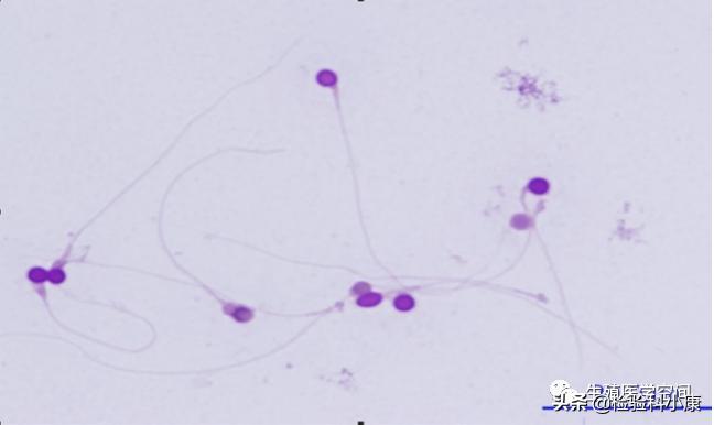 检查精子dna碎片报告怎么看,精子检查哪几项才知道是不是正常