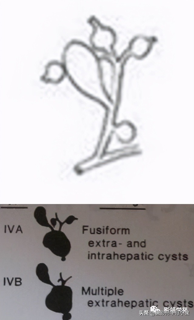 胆总管变异,胆胰管解剖